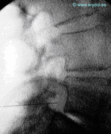 Cirugia de columna