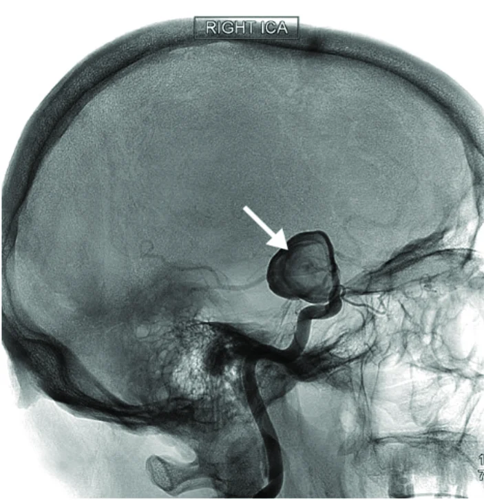 Tratamiento de aneurisma cerebral en Guadalajara