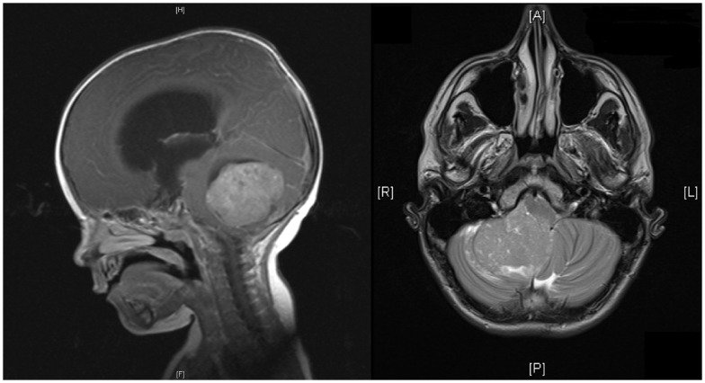 Valoración neuroquirúrgica pediátrica de craneosinostosis
