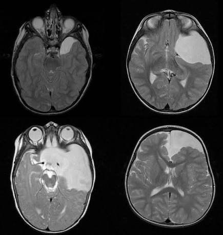 Valoración neuroquirúrgica pediátrica de craneosinostosis