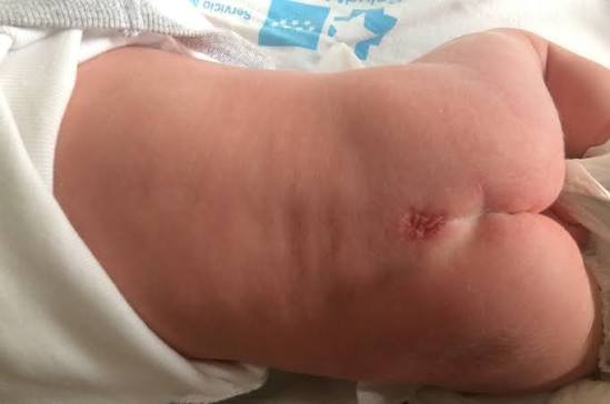 Disrafismo espinal en niños