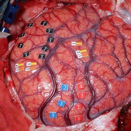 mapeo cerebral en cirugia de tumor cerebral en guadalajara