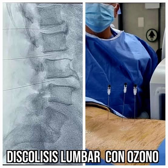 Cirugia de columna