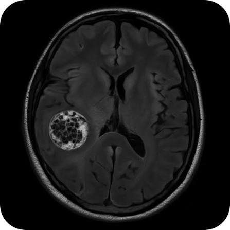 Cavernoma cerebral tratamiento en Guadalajara