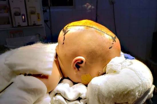 Valoración neuroquirúrgica pediátrica de craneosinostosis
