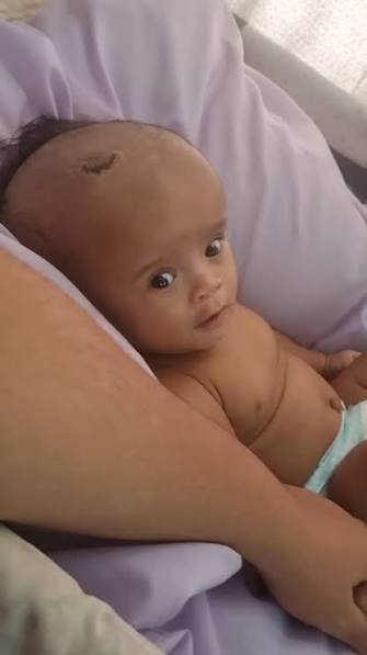 Valoración del perímetro cefálico en un bebé