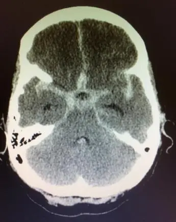 Evento vascular cerebral isquémico y hemorrágico en Guadalajara